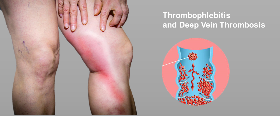 Thrombophlebitis and Deep Vein Thrombosis - TruLight Radio XM