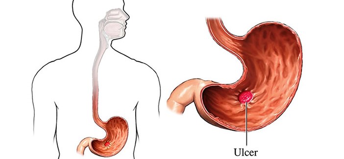 The spiritual reason behind Stomach Ulcers
